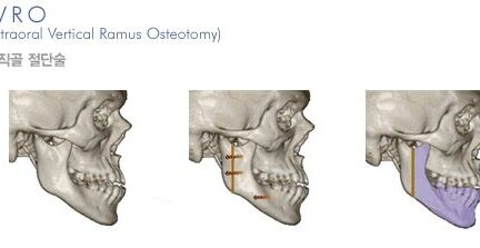 수직골절단술 양악수술, 출혈은 1/4 위험률은 10배나 줄인다