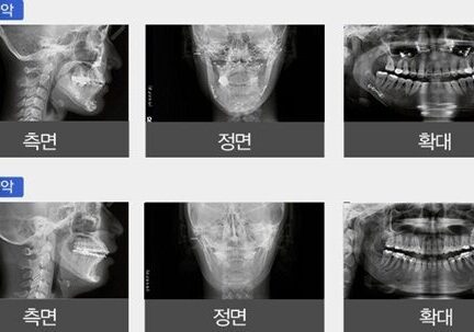 투명양악, 양악수술의 새로운 트렌드로 자리 잡는다