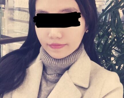 양악수술 후기 10개월 차