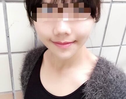 양악(돌출입,비대칭)+광대+턱끝수술 6개월 후 후기입니다.